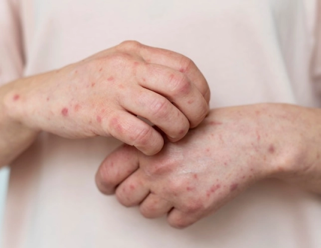 Systemic Lupus Erythematosus