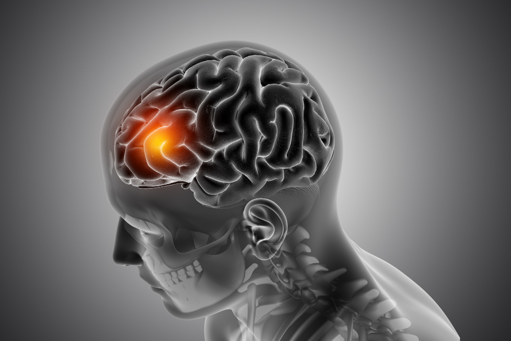 Traumatic Brain Injury (TBI)