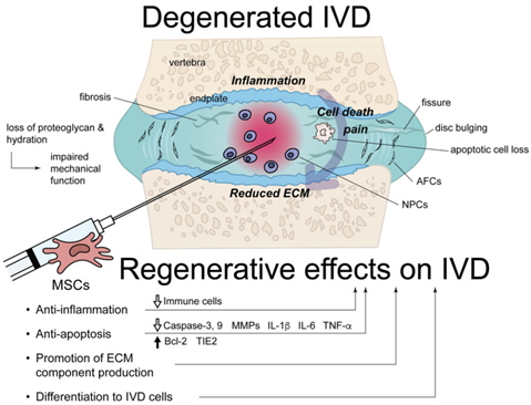 Degenerative Disc Disease & Herniated Disc Pain