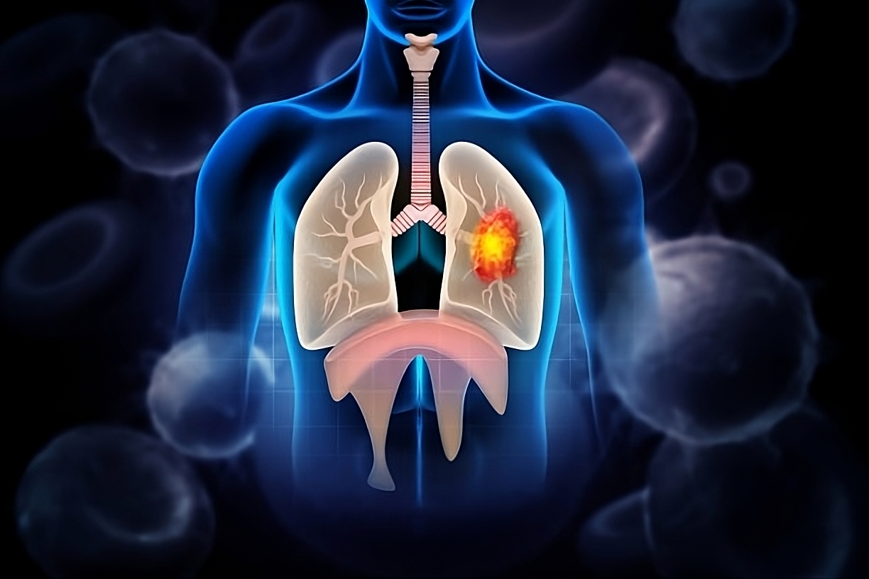 Lung Disease