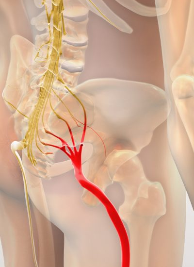 Sciatica
