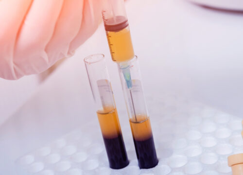 Platelet Rich Plasma